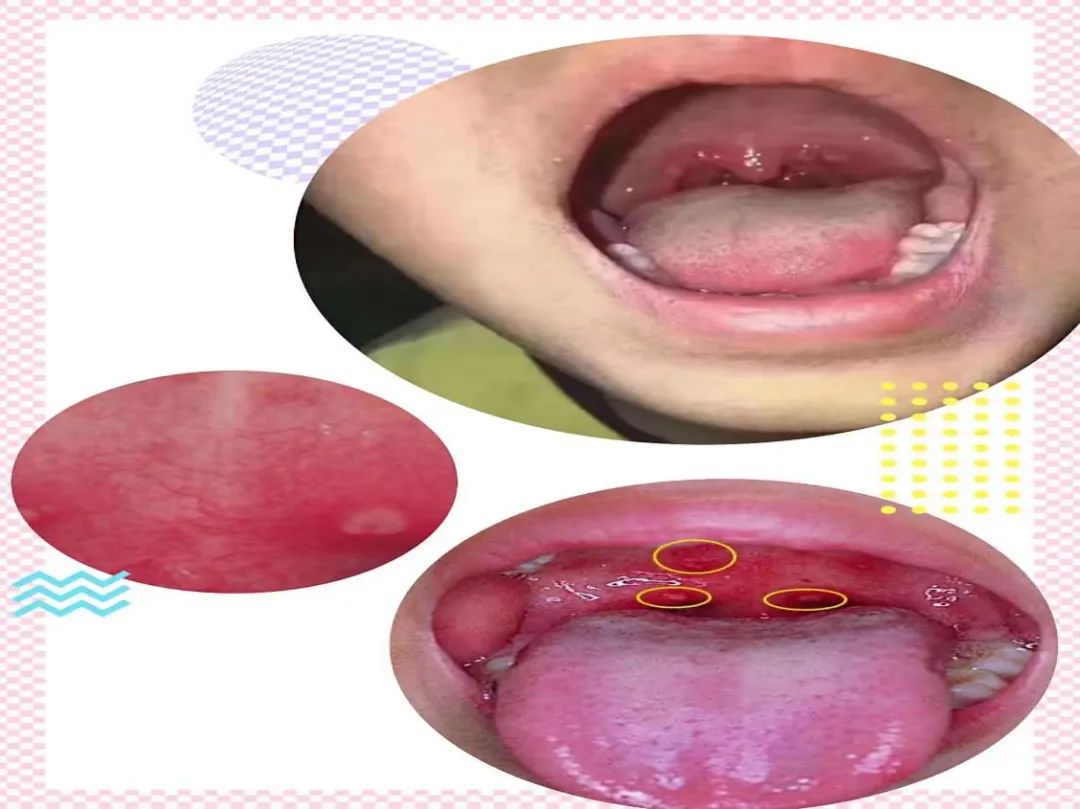 疱疹性咽峡炎怎么护理治疗好得快,儿科疱疹性咽峡炎护理诊断