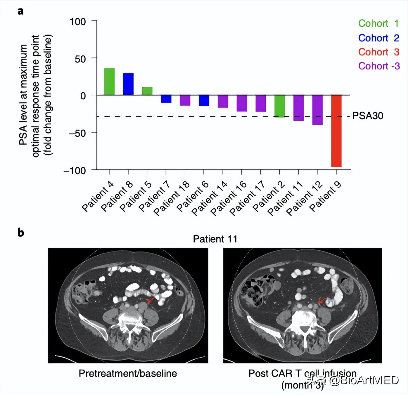 新型car-t疗法,cart治疗前列腺癌