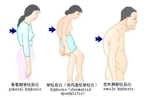 胸腰椎侧凸畸形,腰椎后凸畸形