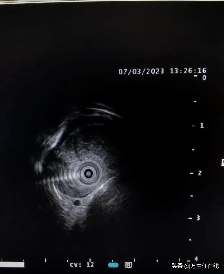 万荣教授上海市第一人民医院,消化内科专家手术