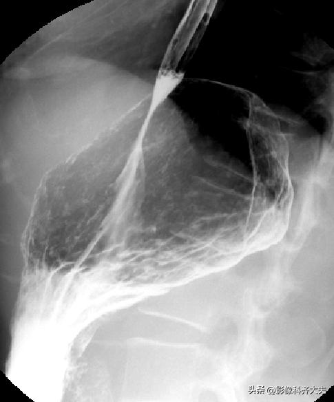 胃肠道造影超声解剖图,胃肠钡餐影像检查片子