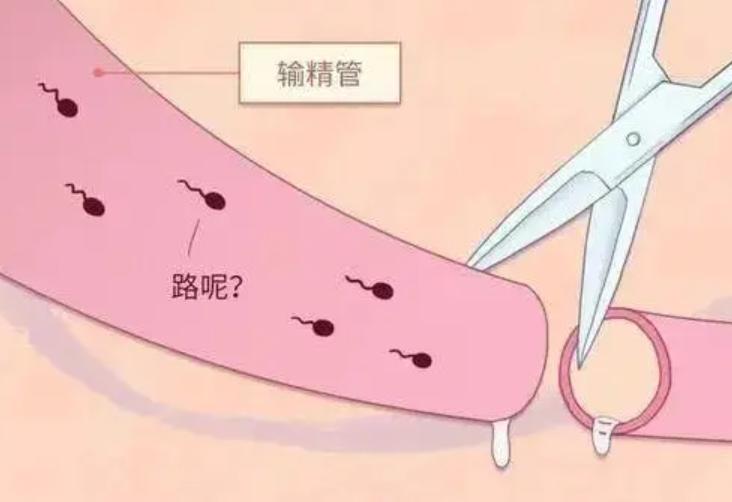 男性结扎了对男性有没有影响,男生做结扎对男性有影响么