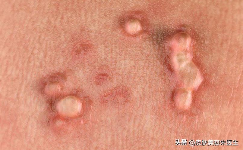 怎么区分尖锐性湿疣和生殖器疱疹,分辨尖锐性湿疣