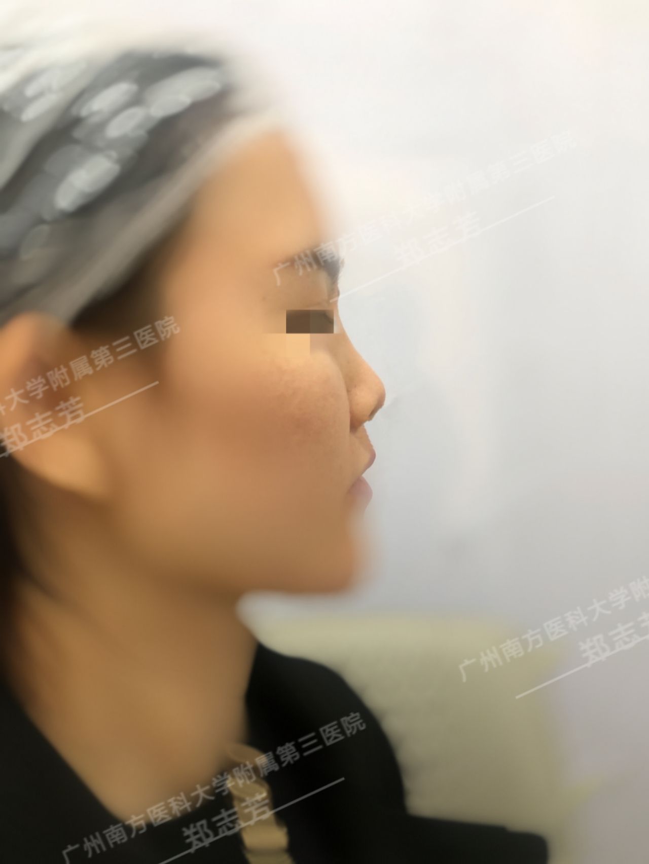 隆鼻后的注意事项和禁忌,隆鼻后需要注意的事项有哪些