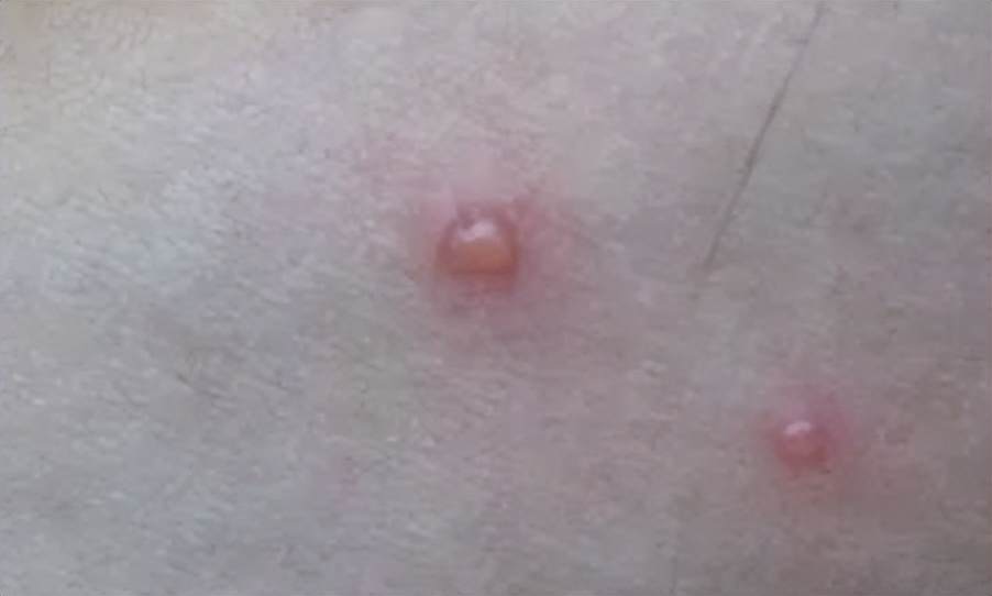 儿童嘴角突然长了一堆小水泡,5岁男童嘴角一圈泡