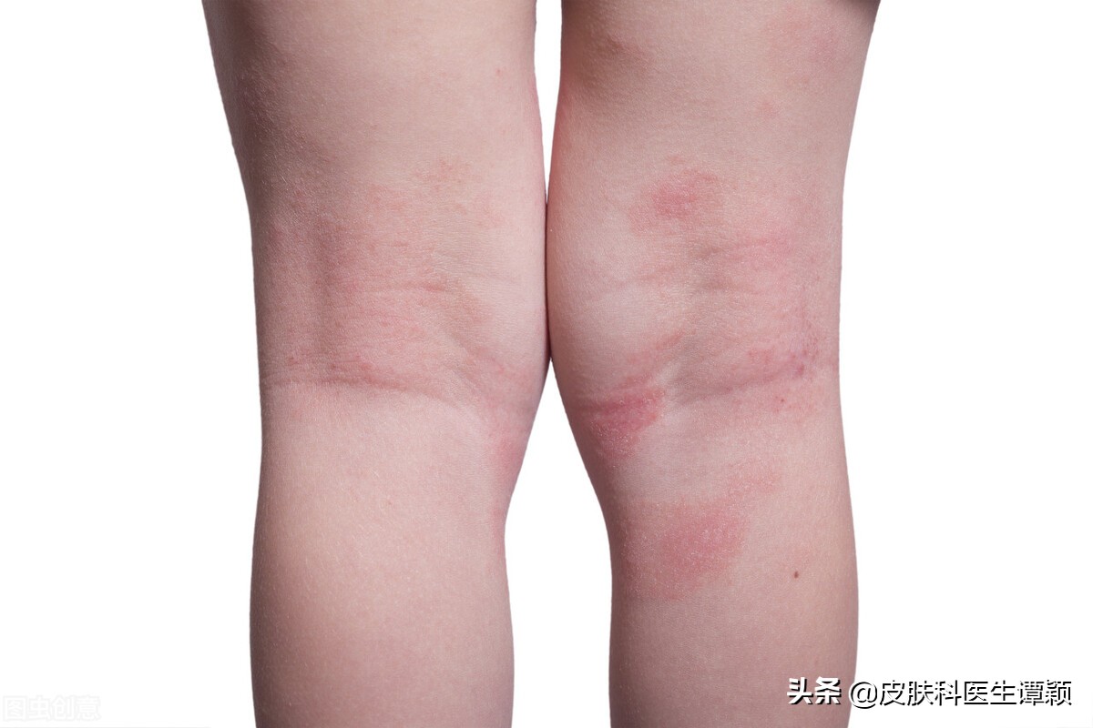 皮肤科医生痱子和湿疹的区别,皮肤科医生如何诊断你是湿疹
