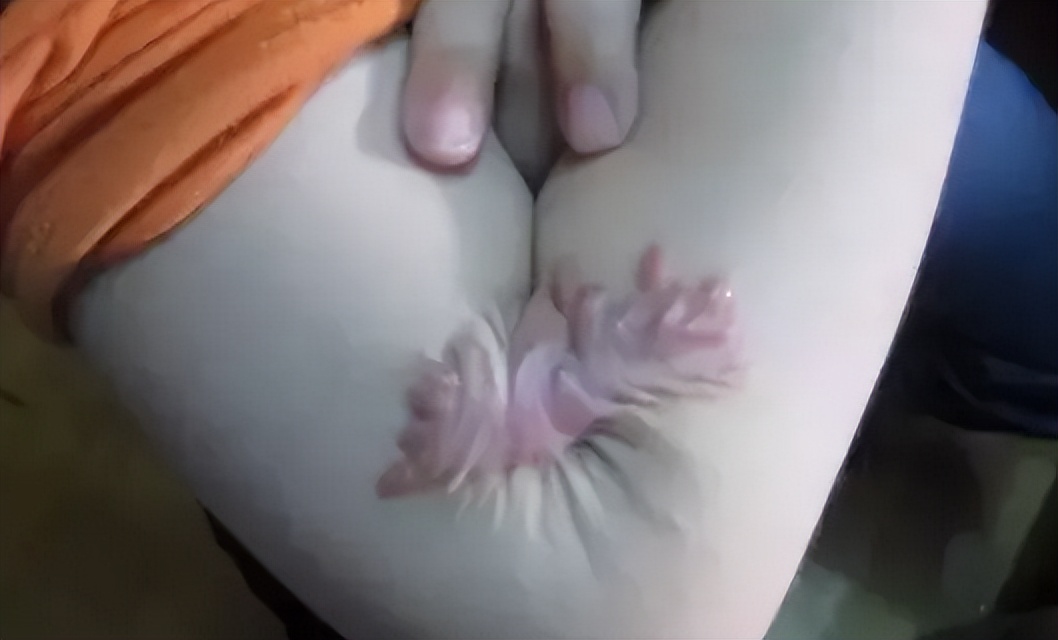 色素疤痕和烫伤疤痕,烧烫伤疤痕好治还是刀伤疤痕好治