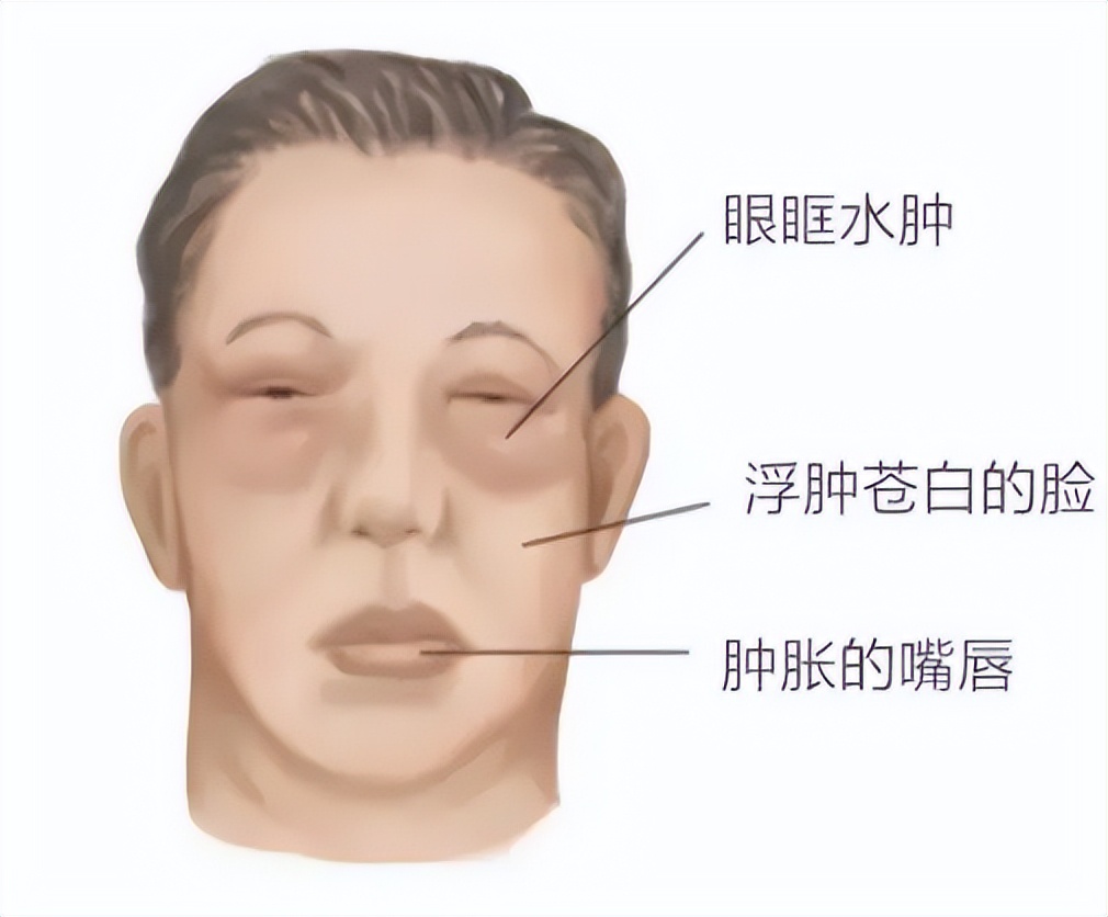 小孩子得了肾炎的症状,孩子肾炎的三大早期症状