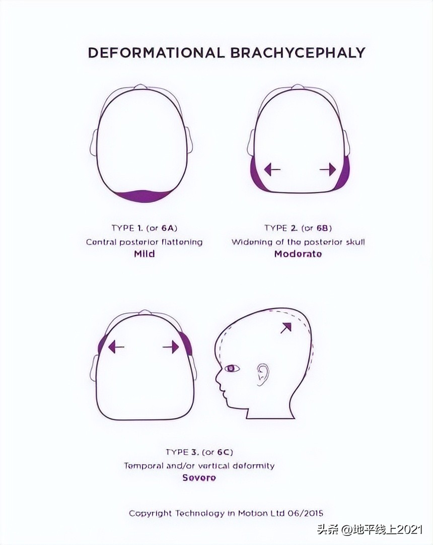 想让孩子有一个漂亮的头型，如何预防和治疗偏头与扁头？