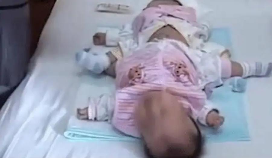 连体婴姐妹18年成功分离,连体婴姐妹成功分离后续