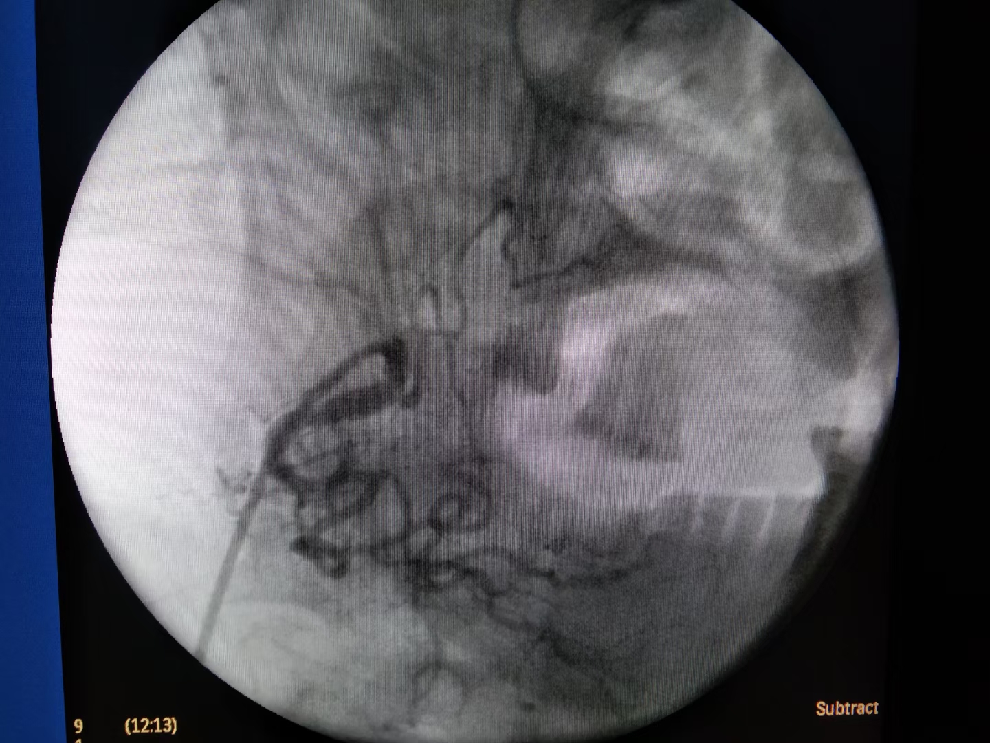 舌癌病例分享,舌癌吐血