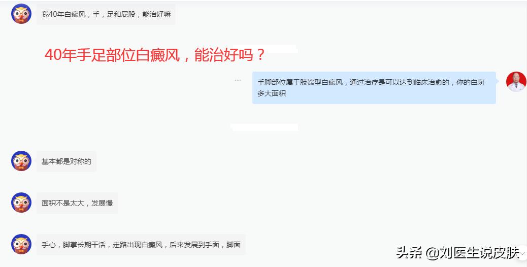 手部的白癜风怎样能治好,手部白癜风怎么治疗最好