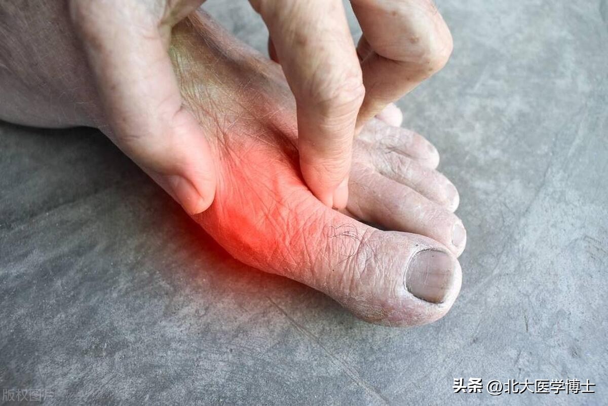 尿酸高湿气重吃什么药,尿酸高痛风祛湿