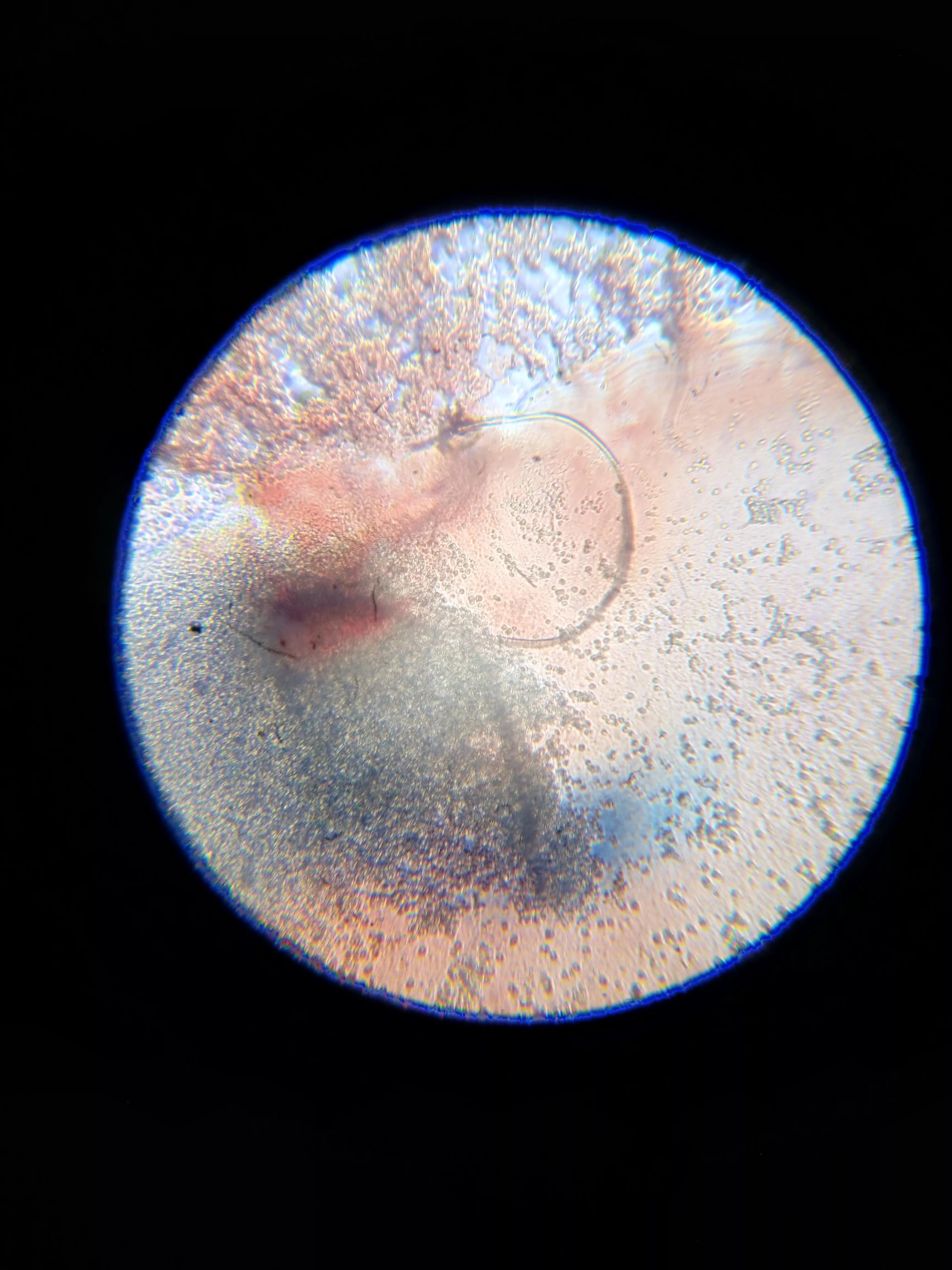 牛皮癣伴随一生是怎么样的体验,对抗牛皮癣一直在坚持