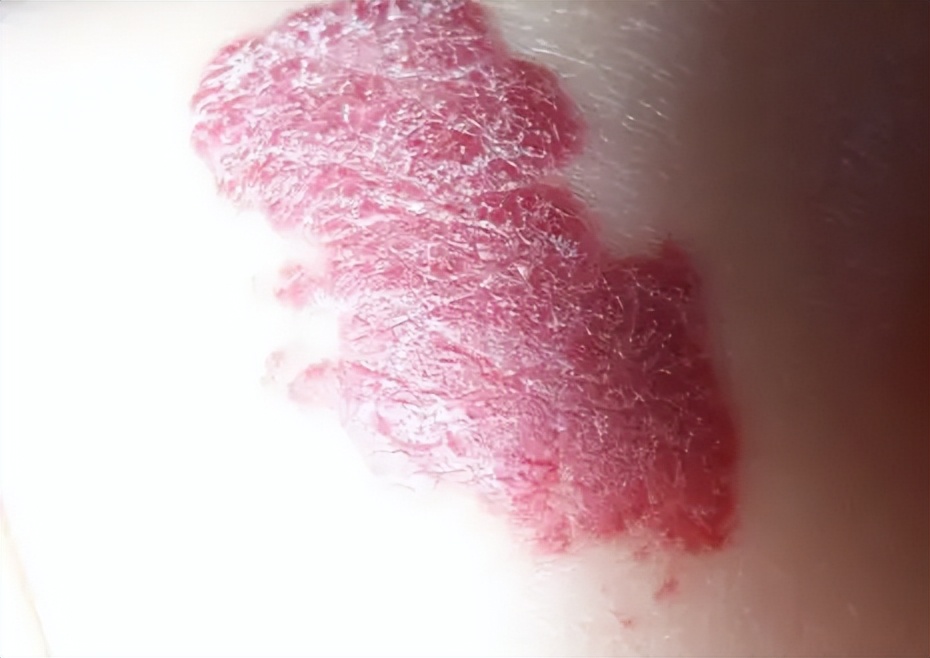 孩子颈部鼓起一个硬包图片,小孩颈部有鼓包颜色变重