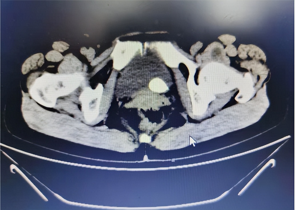 结石堵在泌尿管很痛怎么办,结石引起的尿路堵塞吃什么药