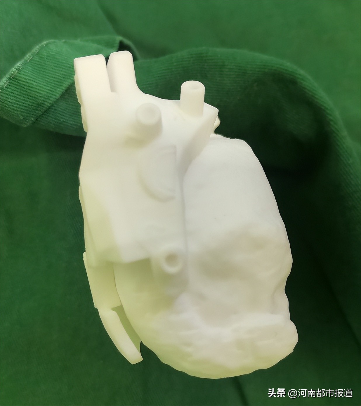 全球首例3d打印距骨表面假体置换,首例医生3d打印距骨表面植入人体