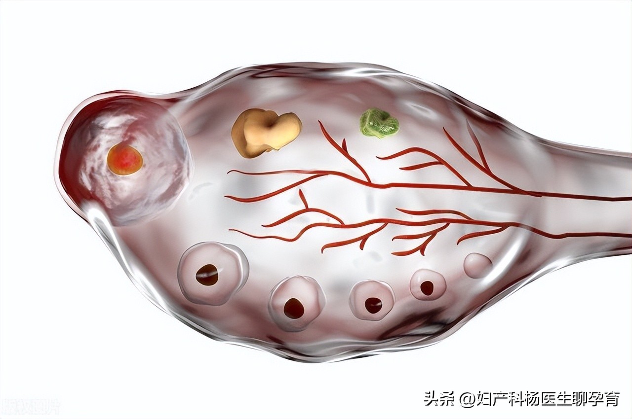 有卵巢囊肿又有多囊卵巢综合征,卵巢囊肿超声检查一般显示什么