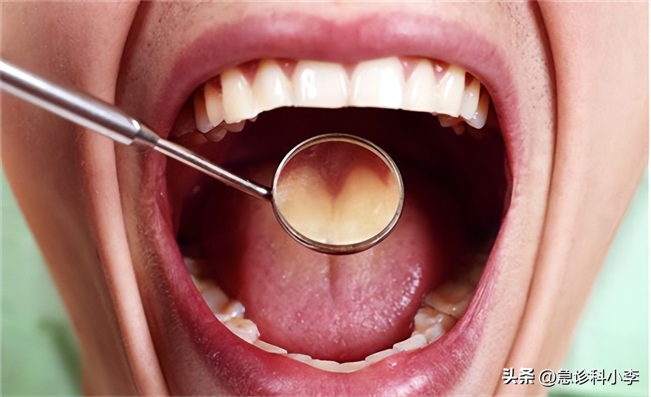 口腔癌有什么症状怎么预防,口腔癌的症状及如何预防