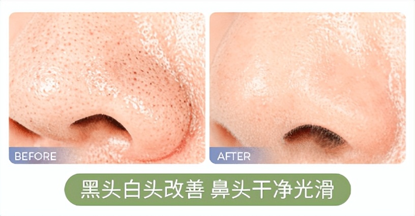 什么面膜清洁毛孔黑头效果好,清洁面膜有用吗真的能清洁毛孔吗