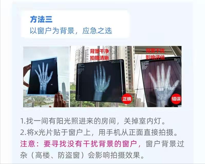 拍骨龄片的正确姿势,如何通过骨龄片看骨龄