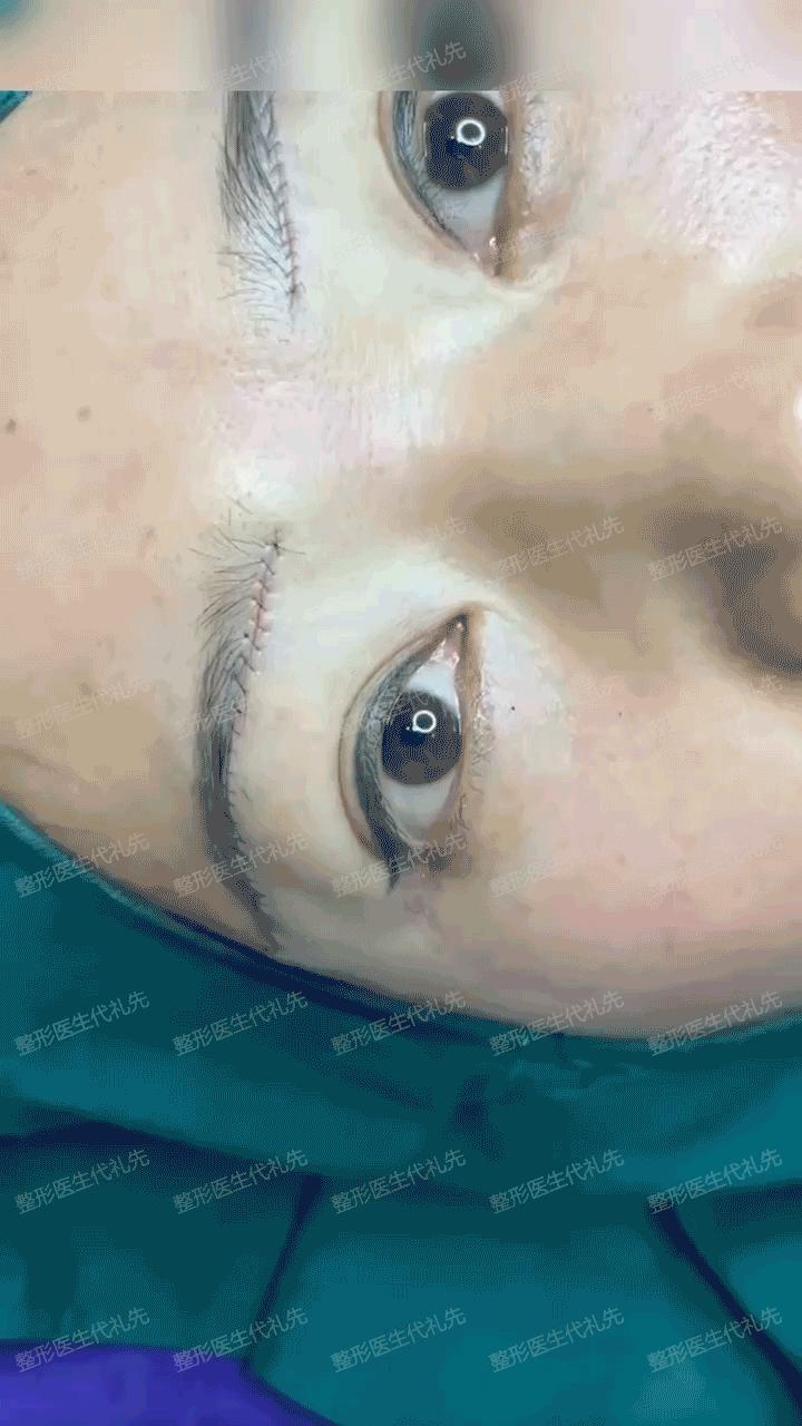 眼窝凹陷眼周脂肪填充眼窝可以吗,眼窝凹陷严重几次眼窝填充好