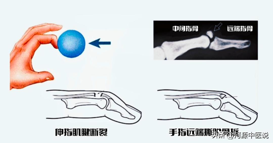 打篮球戳到手指后的治疗方法,打篮球戳到手肿胀怎么回复