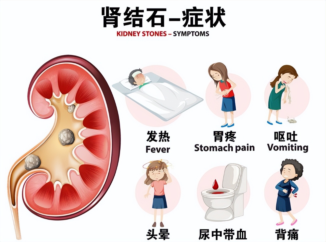 肾结石疼到怀疑人生的图片,肾结石科普一下