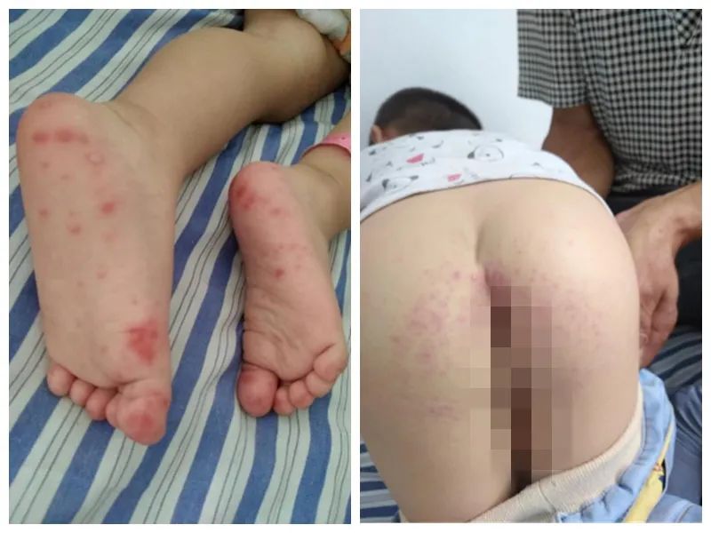 手足口病儿童的3大护理方法,手足口病六个小妙招