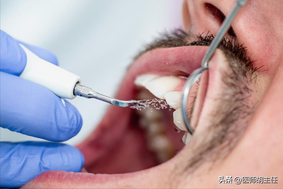 牙缝中的牙结石怎么去除,牙缝的牙结石怎么自己去除