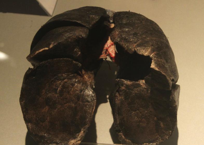 80岁老人肺癌早期治愈率有多少,老年人得肺癌发展很慢吗