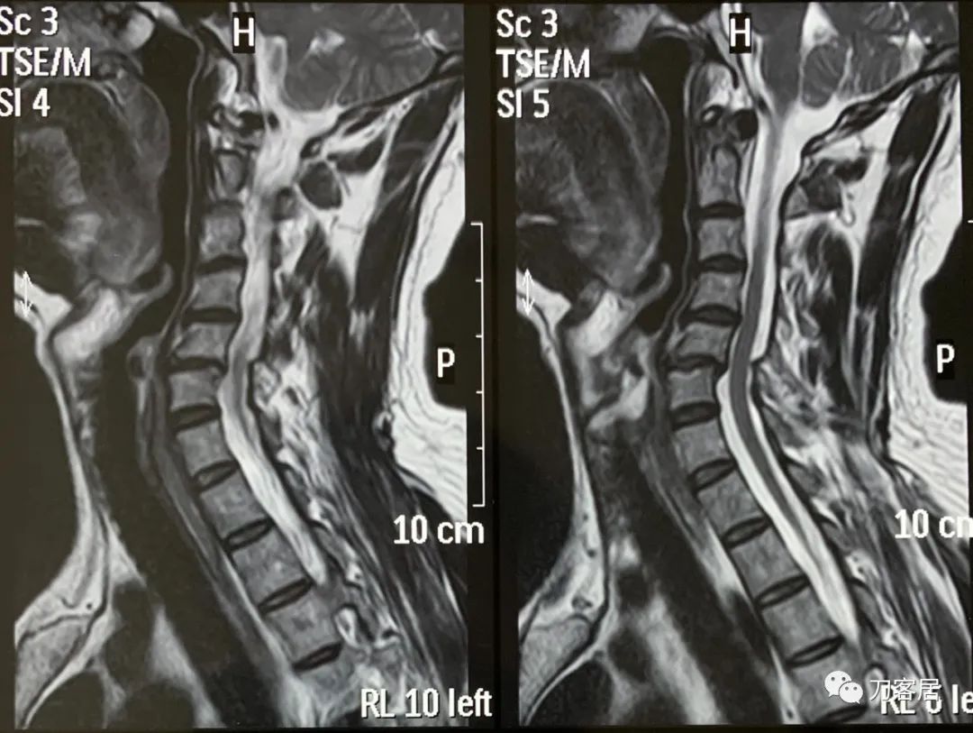右手拇指间歇性麻木，颈椎病，颈椎失稳的保守治疗