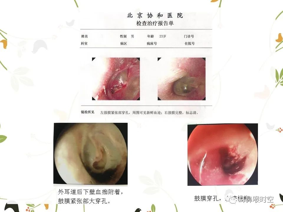 鼓膜可见穿孔,鼓膜穿孔听力下降能恢复吗