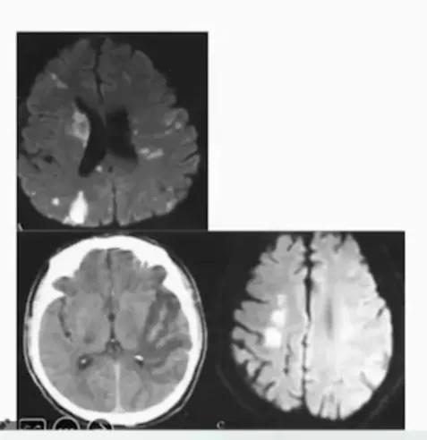 缺血性卒中治疗原则,缺血性卒中病因分型