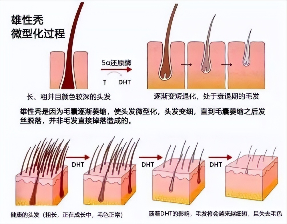 脂溢性脱发一直脱,脂溢性脱发是一直掉么