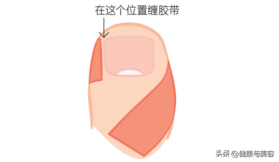 指甲卷曲内卷,指甲卷曲用什么药