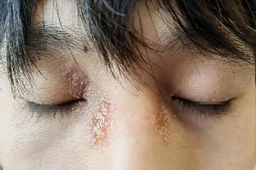 面部皮炎的症状和治疗方法,面部皮炎是怎么回事