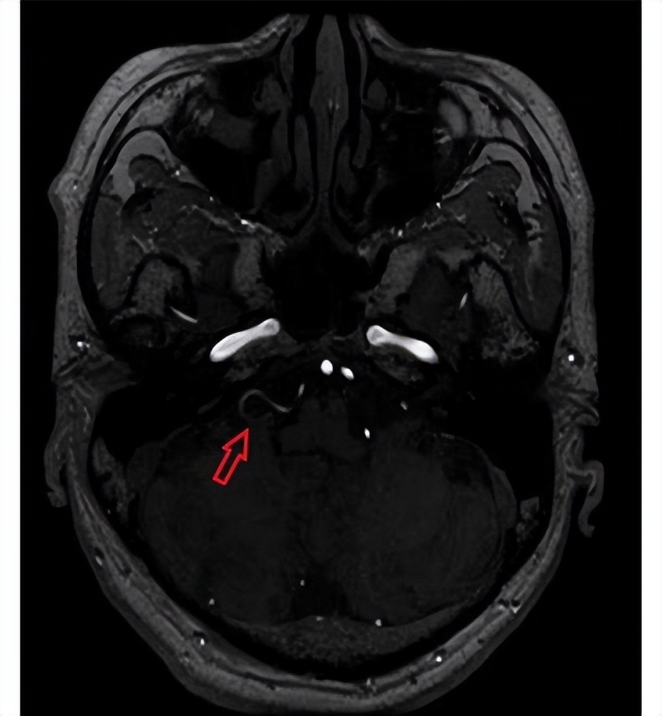 男子咽痛半年医院误诊,男子刀片嗓