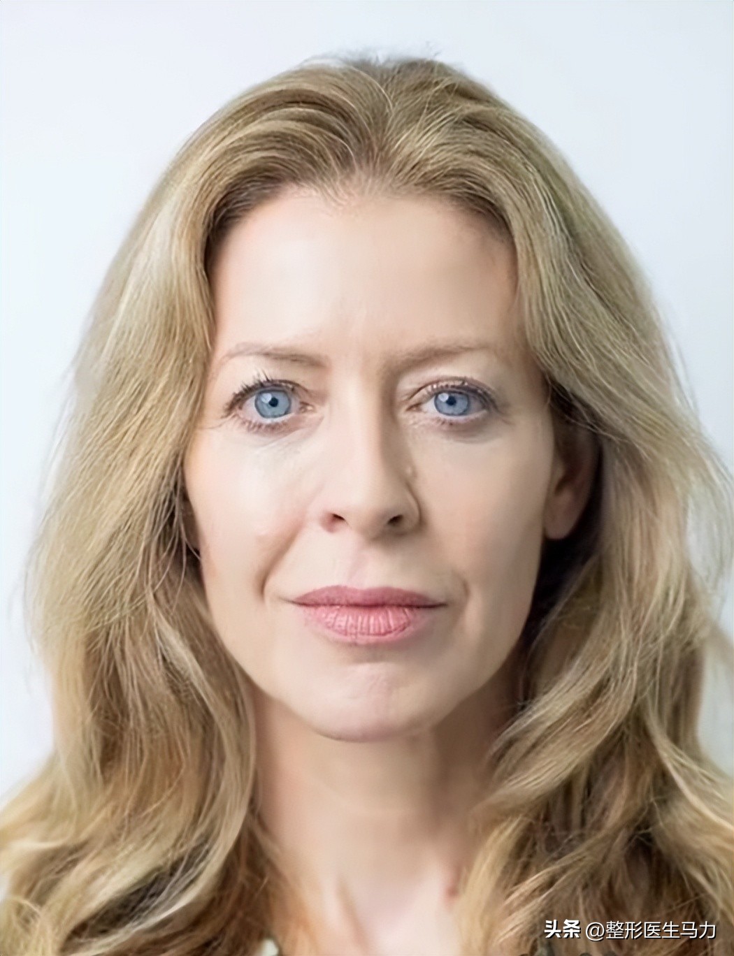 鼻基底玻尿酸栓塞后续治疗方法,鼻基底打玻尿酸栓塞后打溶解酶