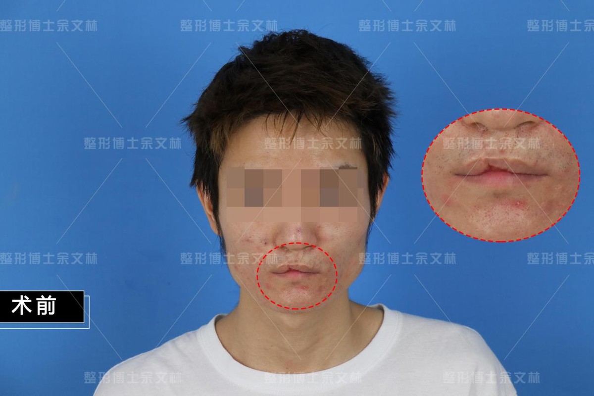 唇裂科普,唇裂修复案例