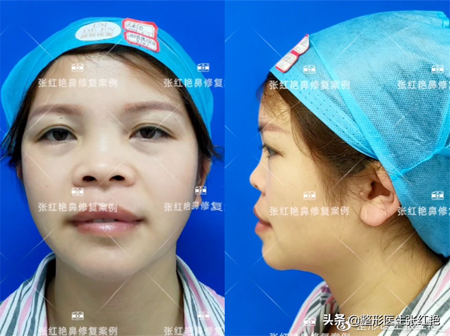 塌鼻头大鼻头怎么修容,塌鼻子和大鼻头如何变高挺