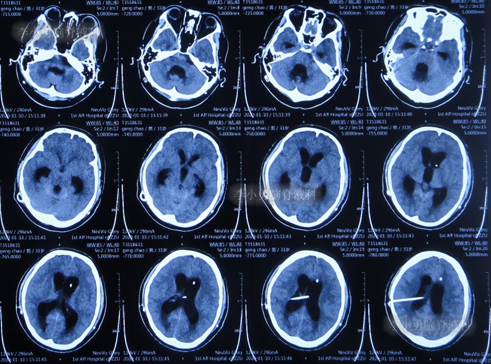 脑积水三脑室造瘘多久能恢复,脑囊虫手术后脑积水
