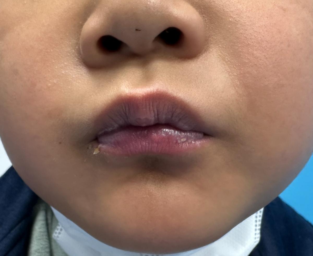 儿童遗传性毛细血管扩张会自愈么,遗传性出血性毛细血管扩张ct表现