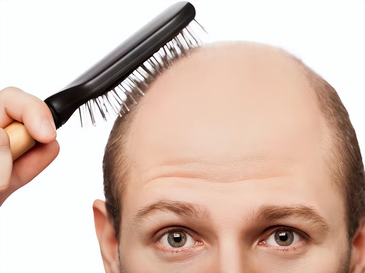 肾亏型脱发和熬夜脱发,熬夜脱发是属于什么脱发