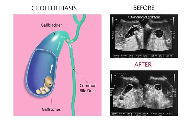 化疗期间转氨酶升高是什么原因,转氨酶升高的原因有哪些