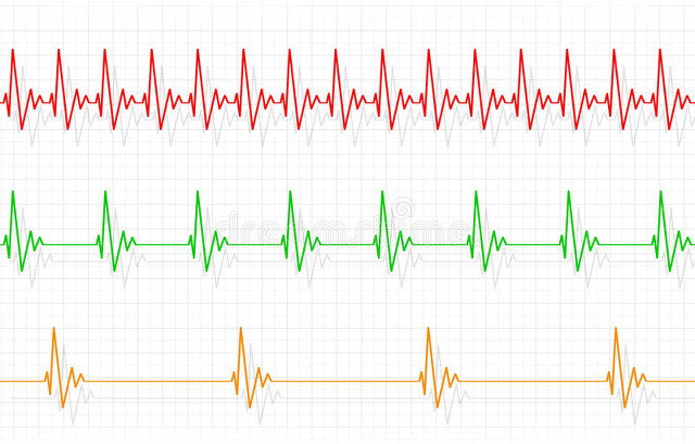 经方治疗心动过缓,中医治疗心动过缓28例体会