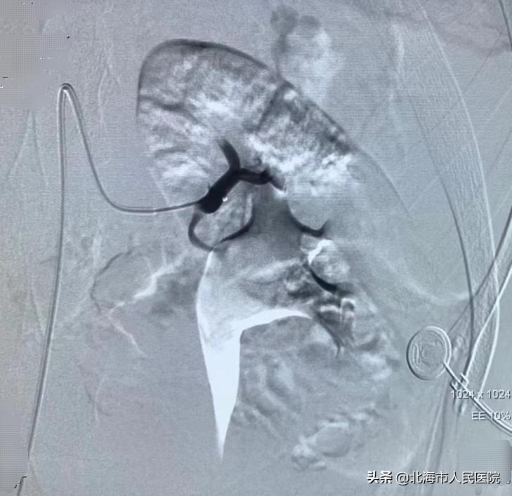 北海一20岁男子骑摩托车摔跤致脾破裂、肾挫伤、频尿血，医生为其微创止血并保住肾脏