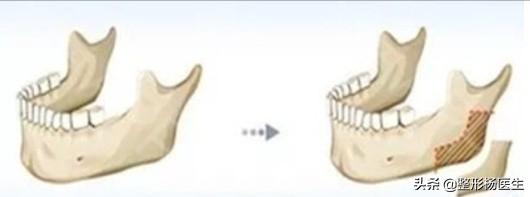 削骨后遗症最严重的后果,削骨失败案例后遗症