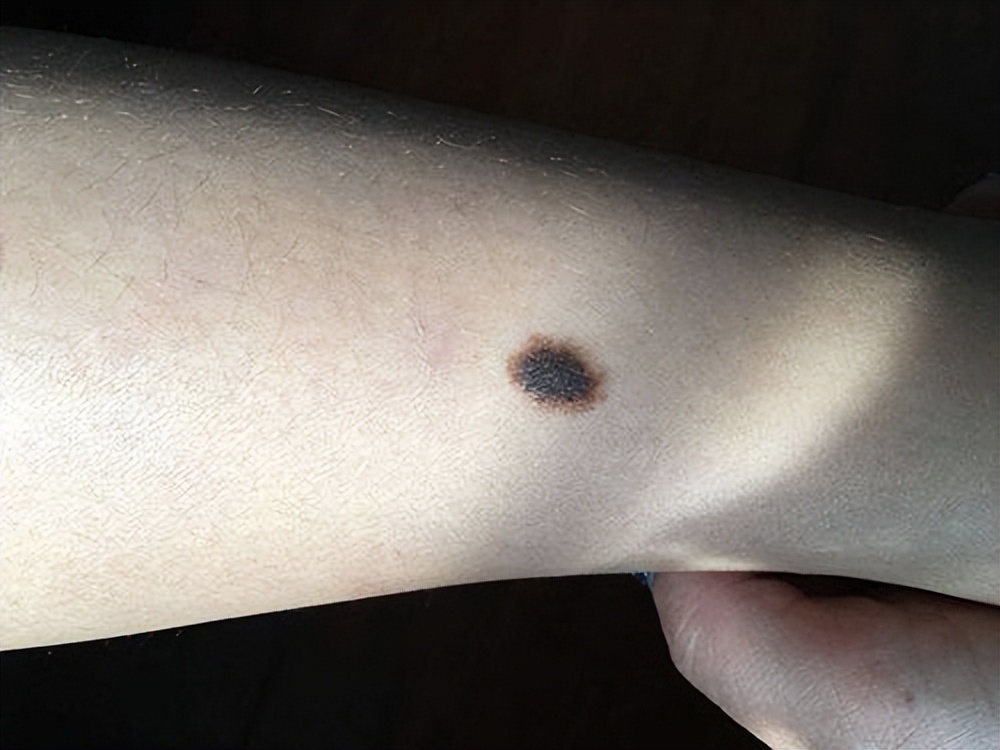 身上长红痣好还是长黑痣好,身上的痣出现这些变化小心会癌变