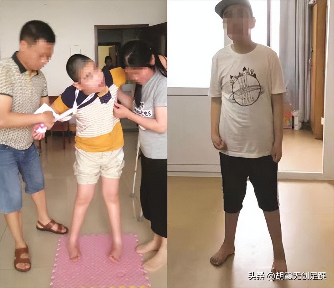 脑瘫后遗症肢体畸形如何矫正,脑瘫足内翻治疗方法